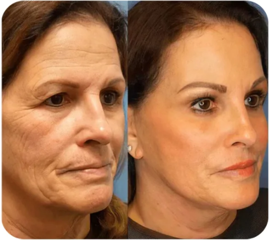 Last Day Discount: 67% OFF 🌸Instant face Tightener No-Filter Primer